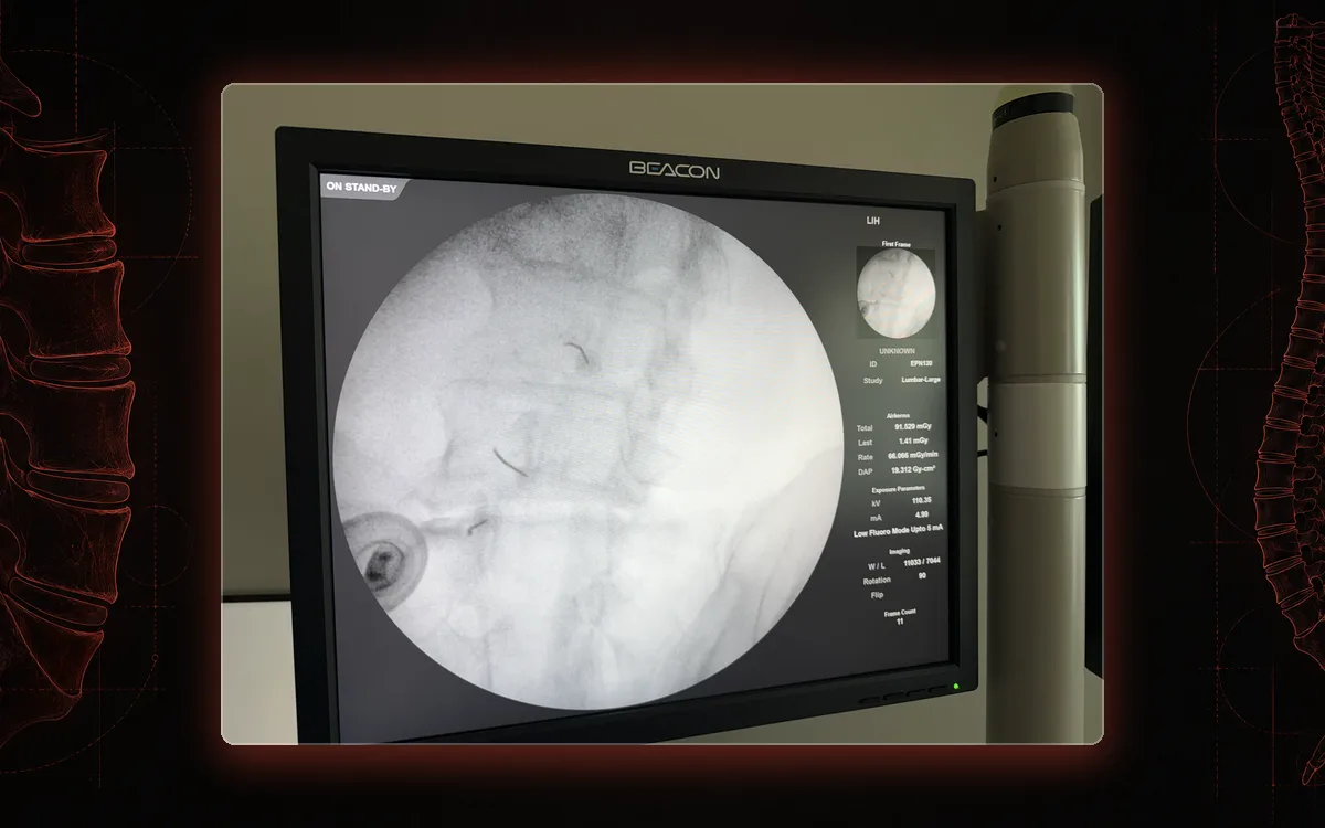Fluoroscopy monitor in our St. Louis procedure suite during a lumbar medial branch block, needle tips on the lumbar medial branch nerves.
