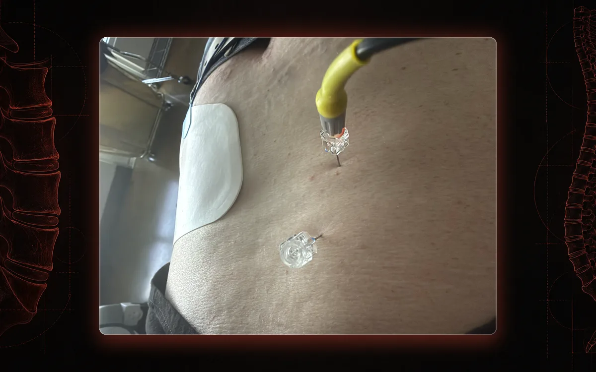 Radiofrequency cannulas in the lower back with the electrode connected during lumbar radiofrequency ablation at our St. Louis clinic.