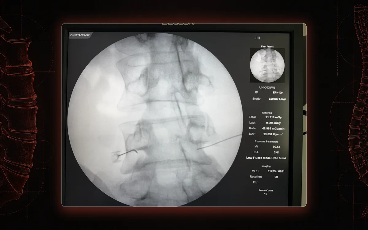Fluoroscopy of the lumbar spine with needle tips at the nerve roots for a selective nerve root block.