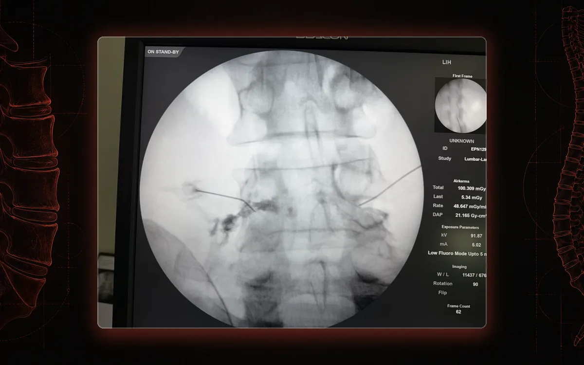 Fluoroscopy of a lumbar selective nerve root block with contrast spreading along the nerve root and into the epidural space.