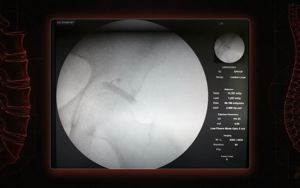 Fluoroscopy of a piriformis injection with contrast outlining the piriformis muscle.
