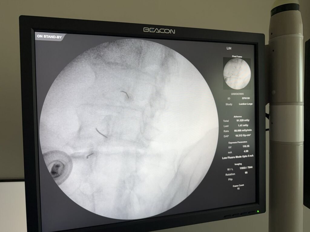 Fluoroscopy monitor in our procedure suite during a lumbar medial branch block, needle tips resting on the lumbar medial branch nerves.