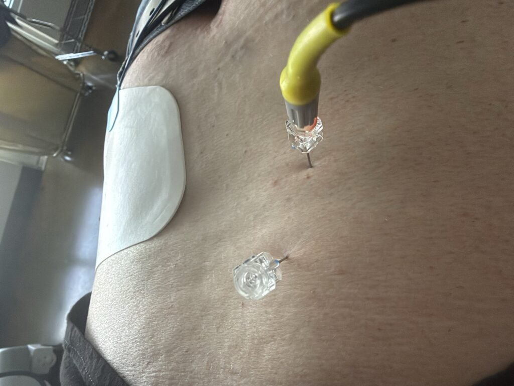 Radiofrequency cannulas placed through the skin of the lower back with the electrode connected and a grounding pad in place during lumbar radiofrequency ablation.