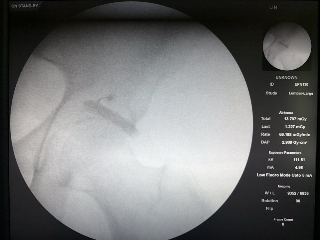 Fluoroscopic image of a piriformis injection, contrast dye outlining the piriformis muscle deep in the buttock.