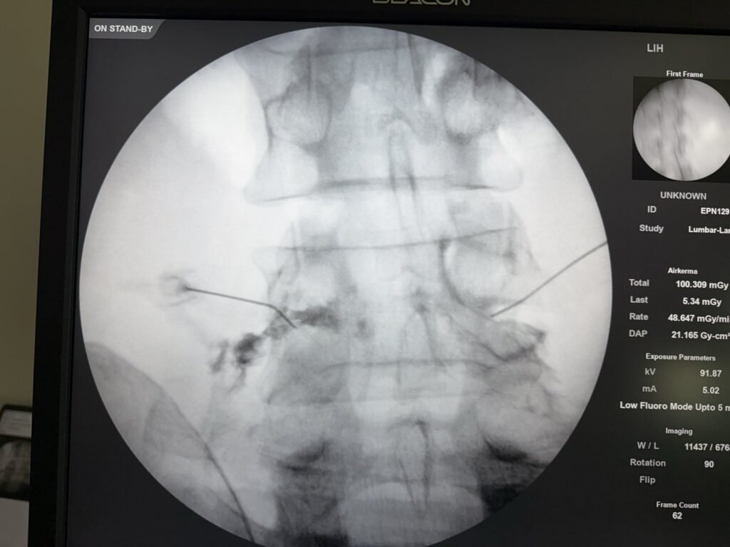 Fluoroscopic image of a lumbar selective nerve root block showing contrast dye spreading along the nerve root and into the epidural space.