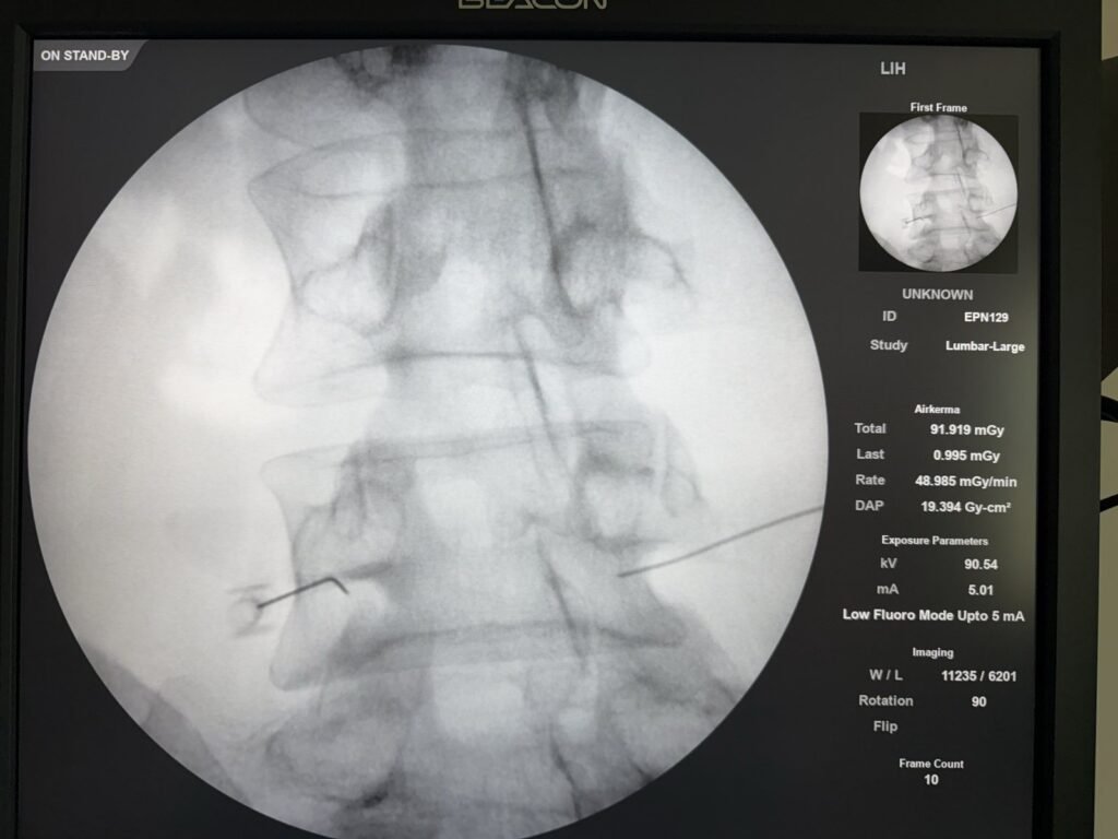 Fluoroscopic view of the lumbar spine with needle tips positioned at the nerve roots for a selective nerve root block.